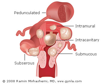 Uterine Fibroids - Surgery