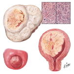 Uterine Sarcoma