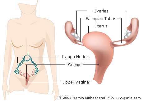 Cervical Cancer Treatment