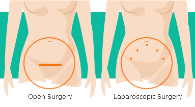 Laparoscopic Surgery