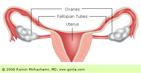 Ovarian Cancer