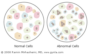 Management of Abnormal Pap Smears