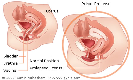 Treatment of Pelvic Prolapse
