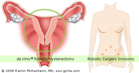 da Vinci Robotic Hysterectomy