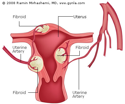 Uterine Fibroids